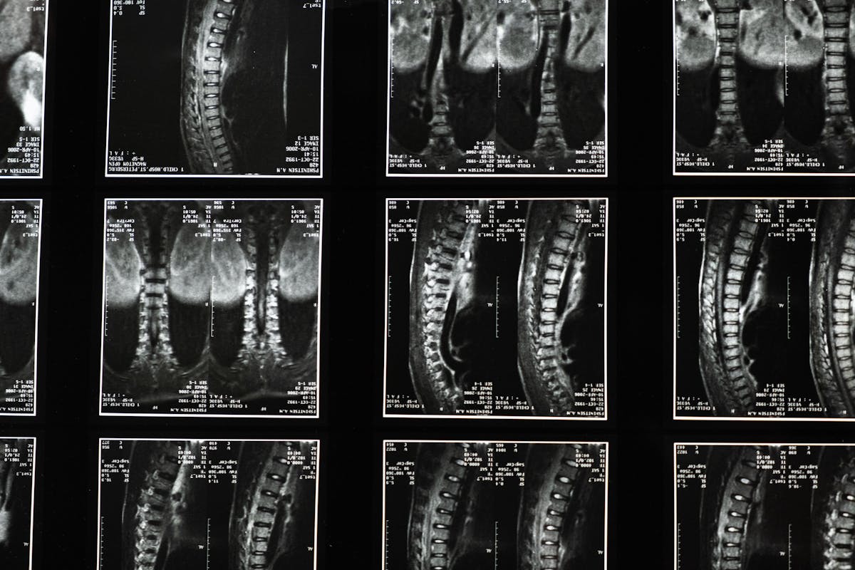 spinal cord